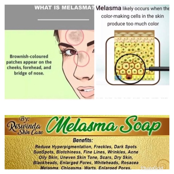 roswinda melasma soap